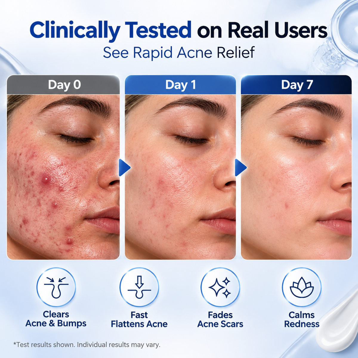 Drying Lotion Acne Treatment 20ml